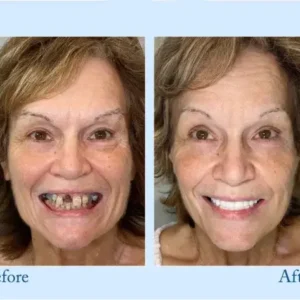 𝐇𝐢𝐝𝐨𝐧𝐞® – Premium Dentures