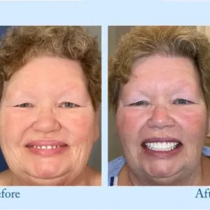 𝐇𝐢𝐝𝐨𝐧𝐞® – Premium Dentures