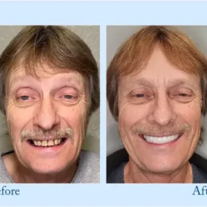𝐇𝐢𝐝𝐨𝐧𝐞® – Premium Dentures
