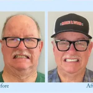 𝐇𝐢𝐝𝐨𝐧𝐞® – Premium Dentures