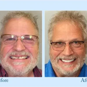 𝐇𝐢𝐝𝐨𝐧𝐞® – Premium Dentures
